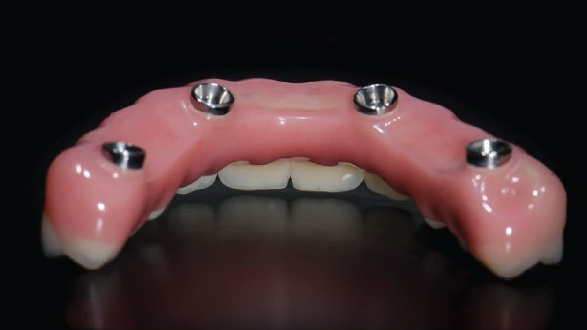 All On 4 Clinic Dr Alex Fibishenko Four Dental Implants 1 DSC 1176 Web 1