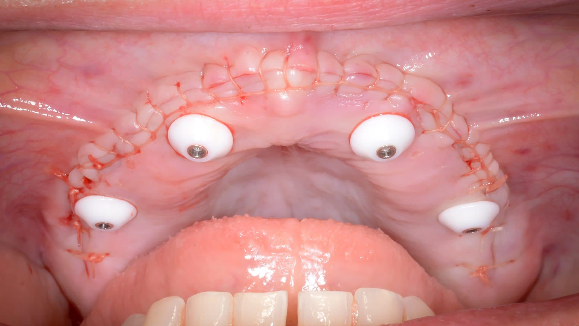 All On 4 Clinic Dr Alex Fibishenko Four Dental Implants 3 DSC 5092 Web