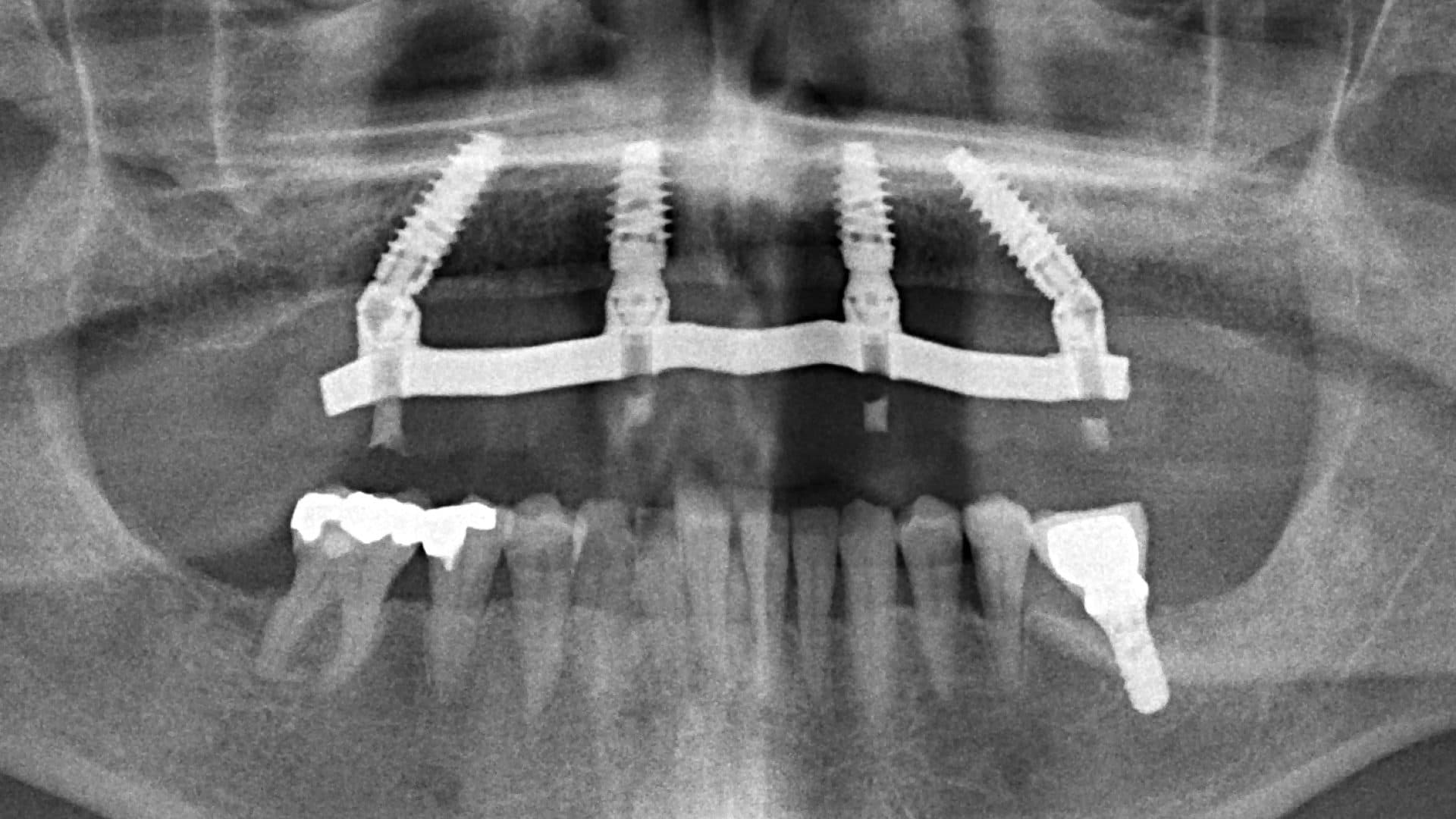 All On 4 Clinic Dr Alex Fibishenko Four Dental Implants 4 Web