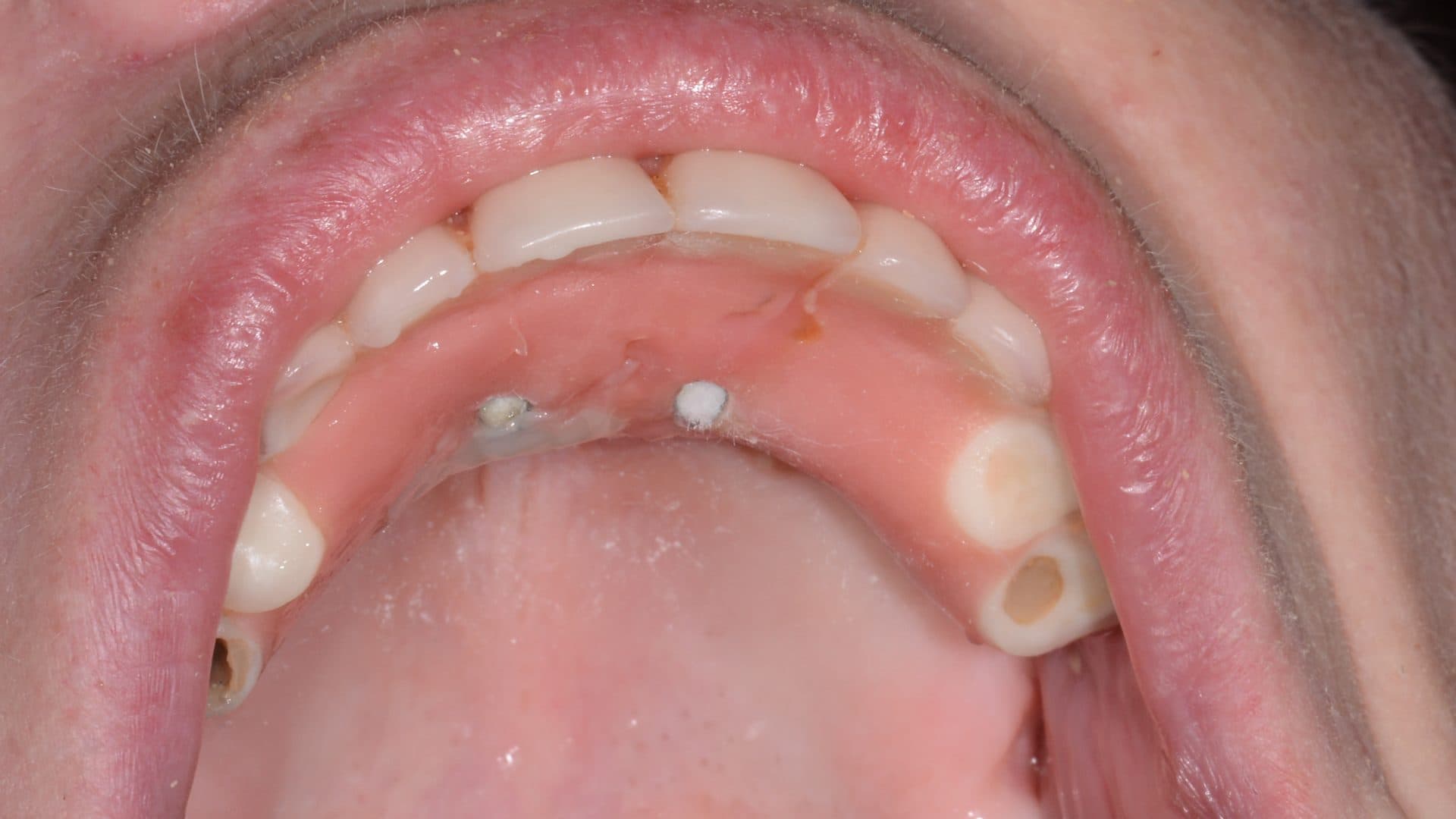 Dental Implants Complications All On 4 Immediate Provisional Acrylic Breakage Implant Failure 1 DSC 2763 Web