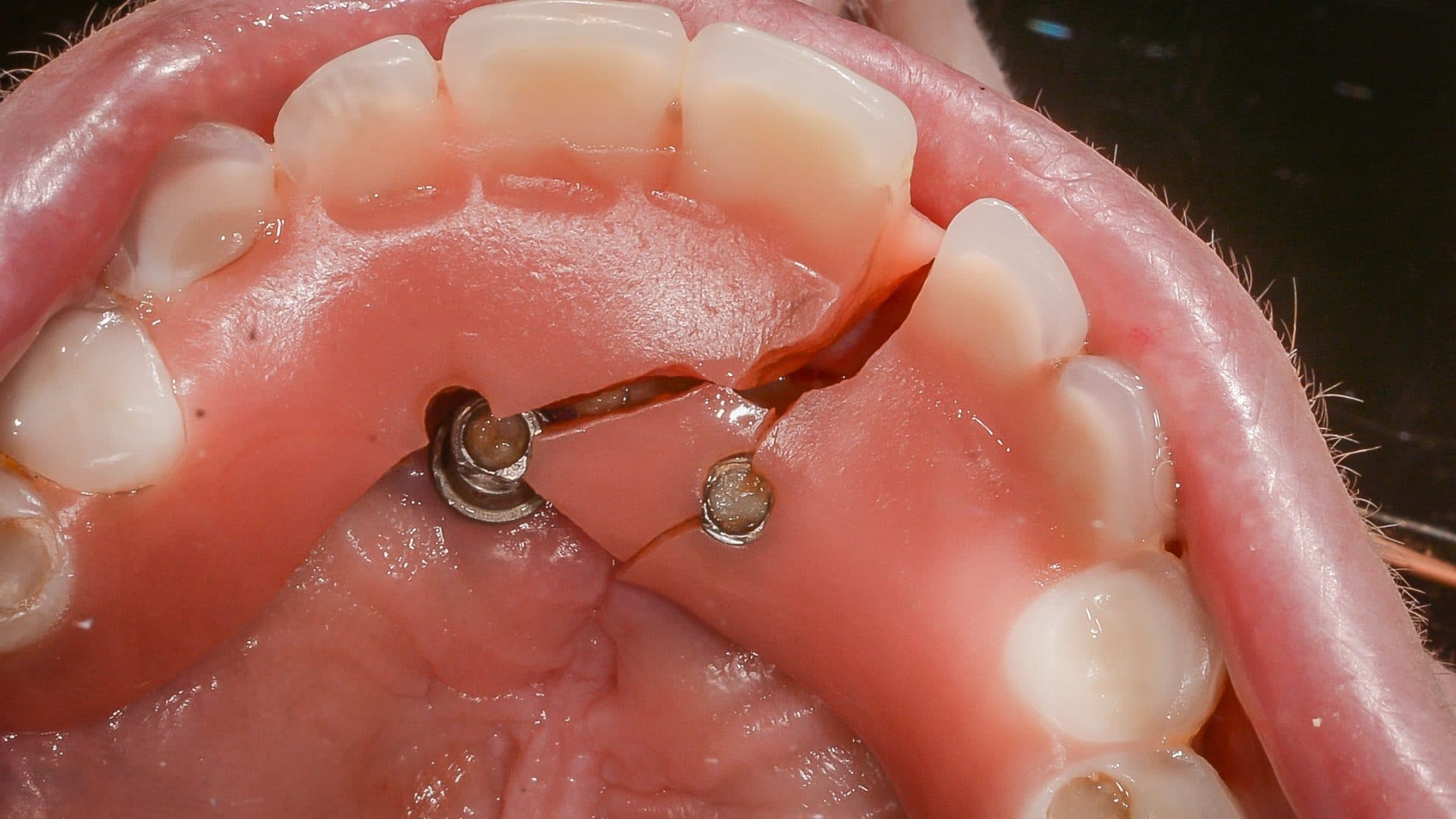 Dental Implants Complications All On 4 Immediate Provisional Acrylic Breakage Implant Failure 2 DSC 2759 Web