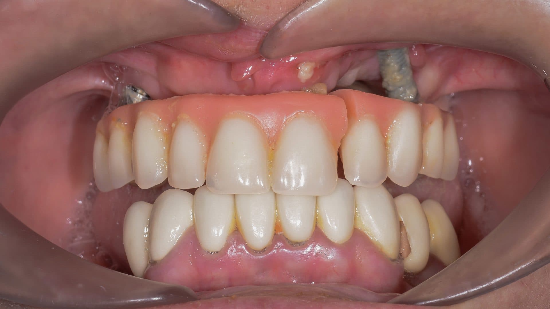 Dental Implants Complications All On 4 Immediate Provisional Acrylic Breakage Implant Failure 3 DSC 2755 Web