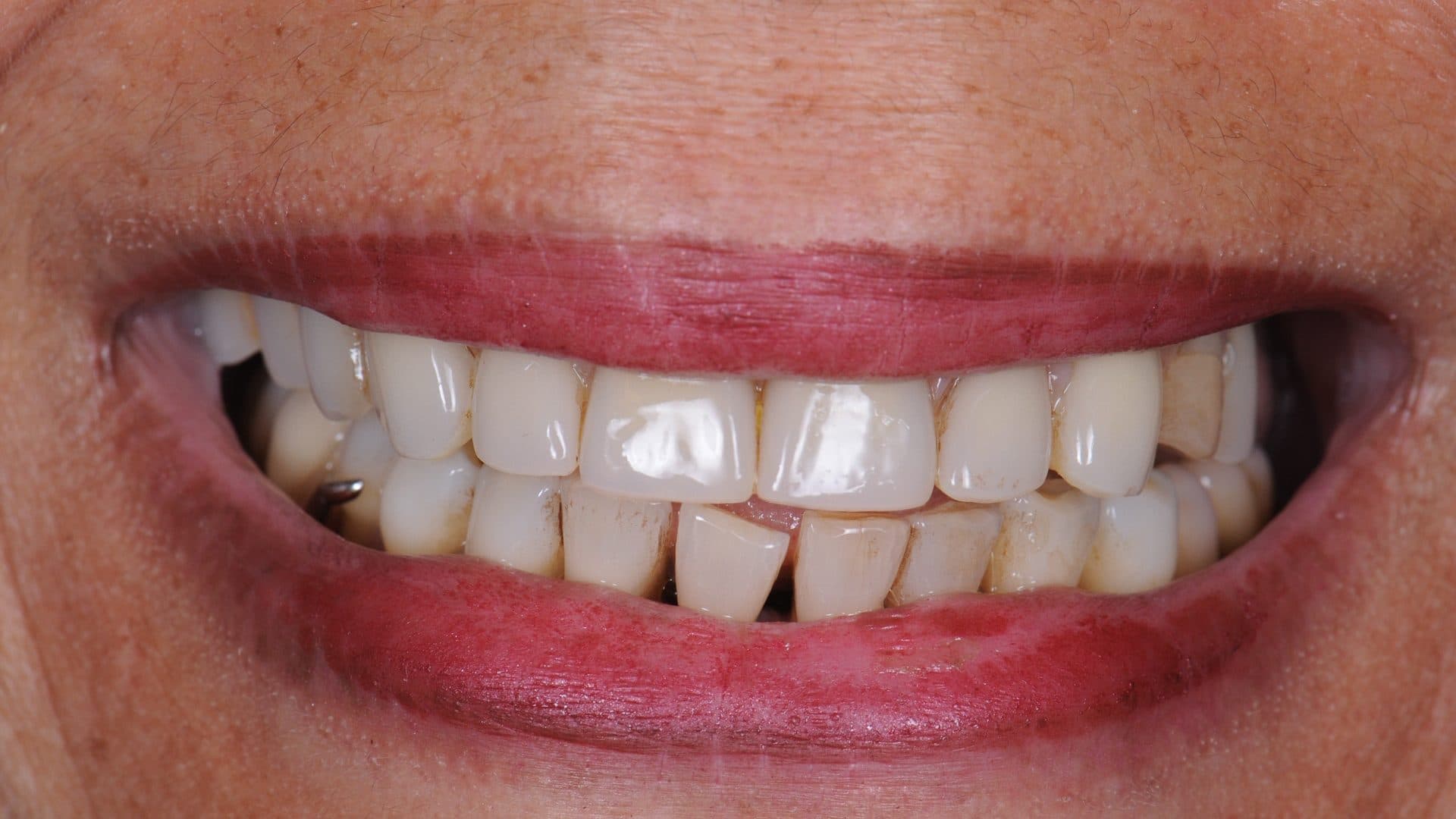 Dental Implants Complications All On 6 Poor Placement Mini Flanges Cleaning Problems Infections Bone Loss 1 DSC 5151 440 Web