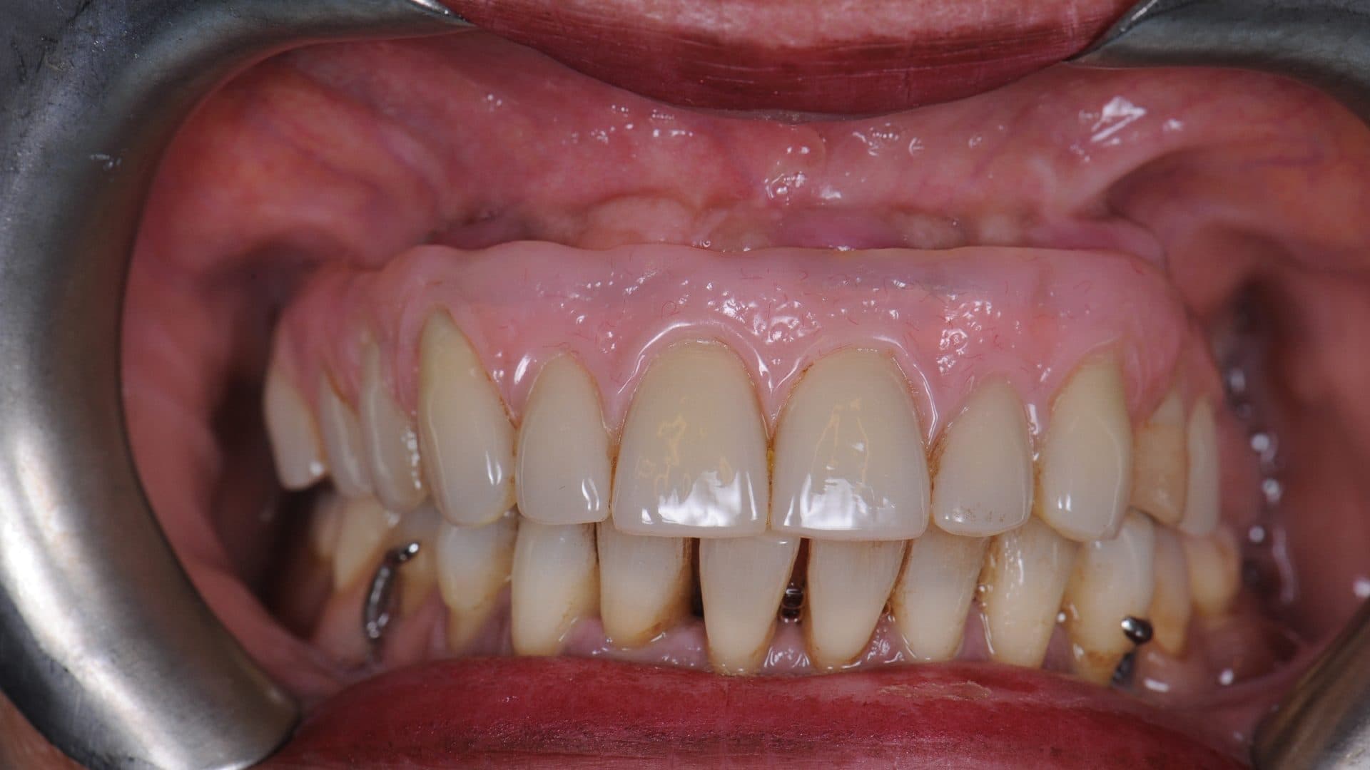 Dental Implants Complications All On 6 Poor Placement Mini Flanges Cleaning Problems Infections Bone Loss 2 DSC 5160 312 Web