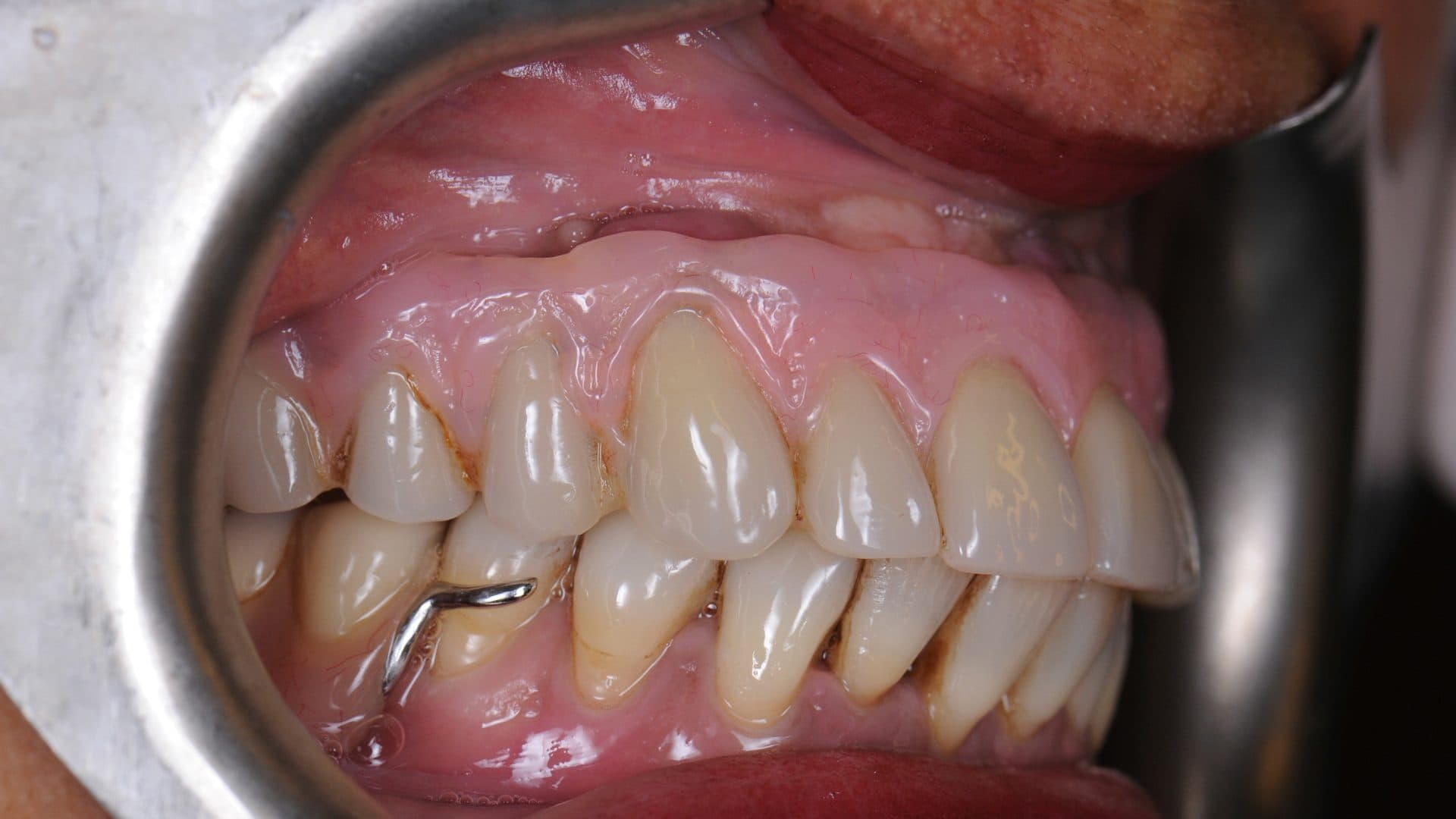 Dental Implants Complications All On 6 Poor Placement Mini Flanges Cleaning Problems Infections Bone Loss 3 DSC 5157 431 Web