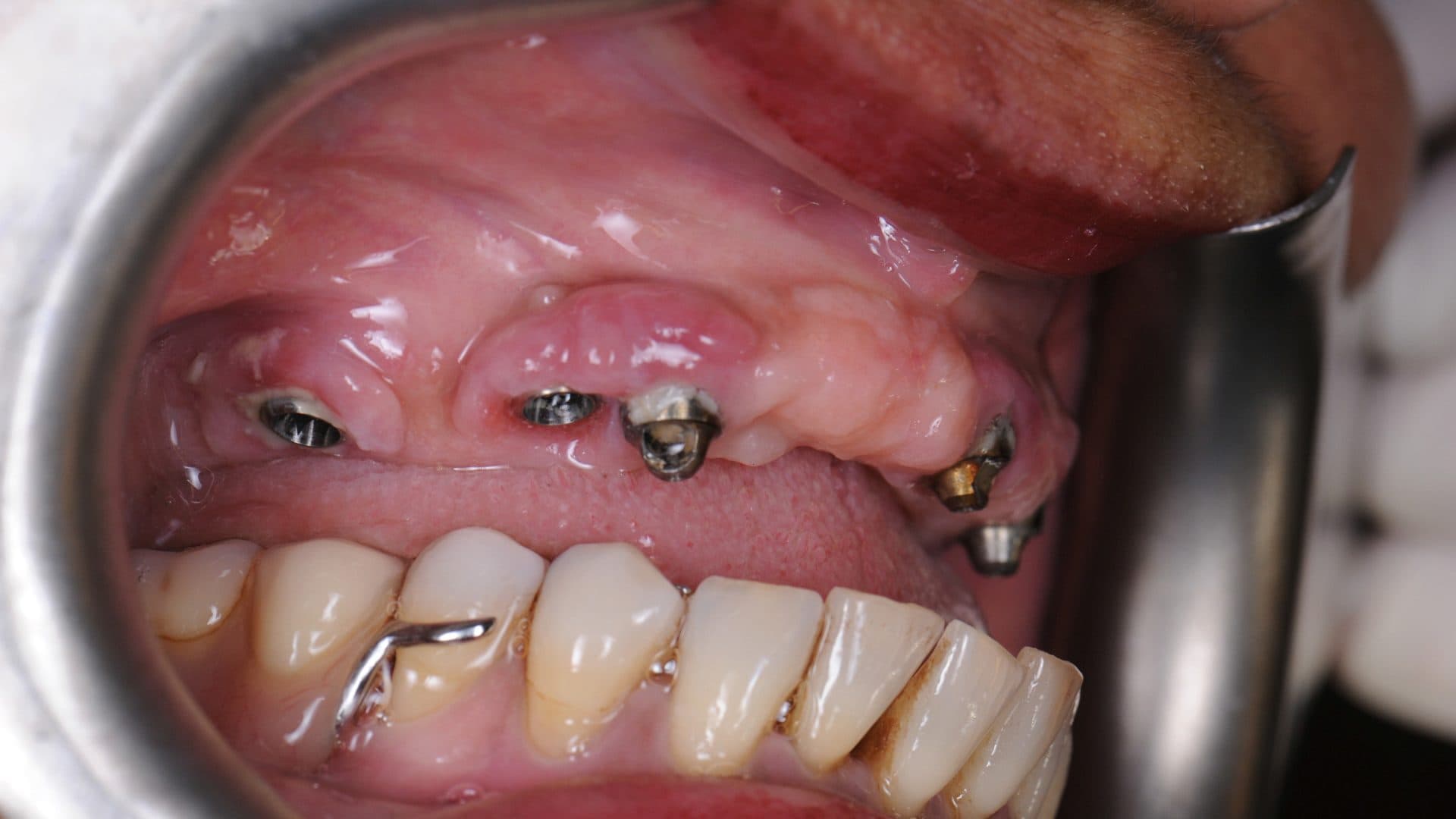 Dental Implants Complications All On 6 Poor Placement Mini Flanges Cleaning Problems Infections Bone Loss 4 DSC 5166 320 Web