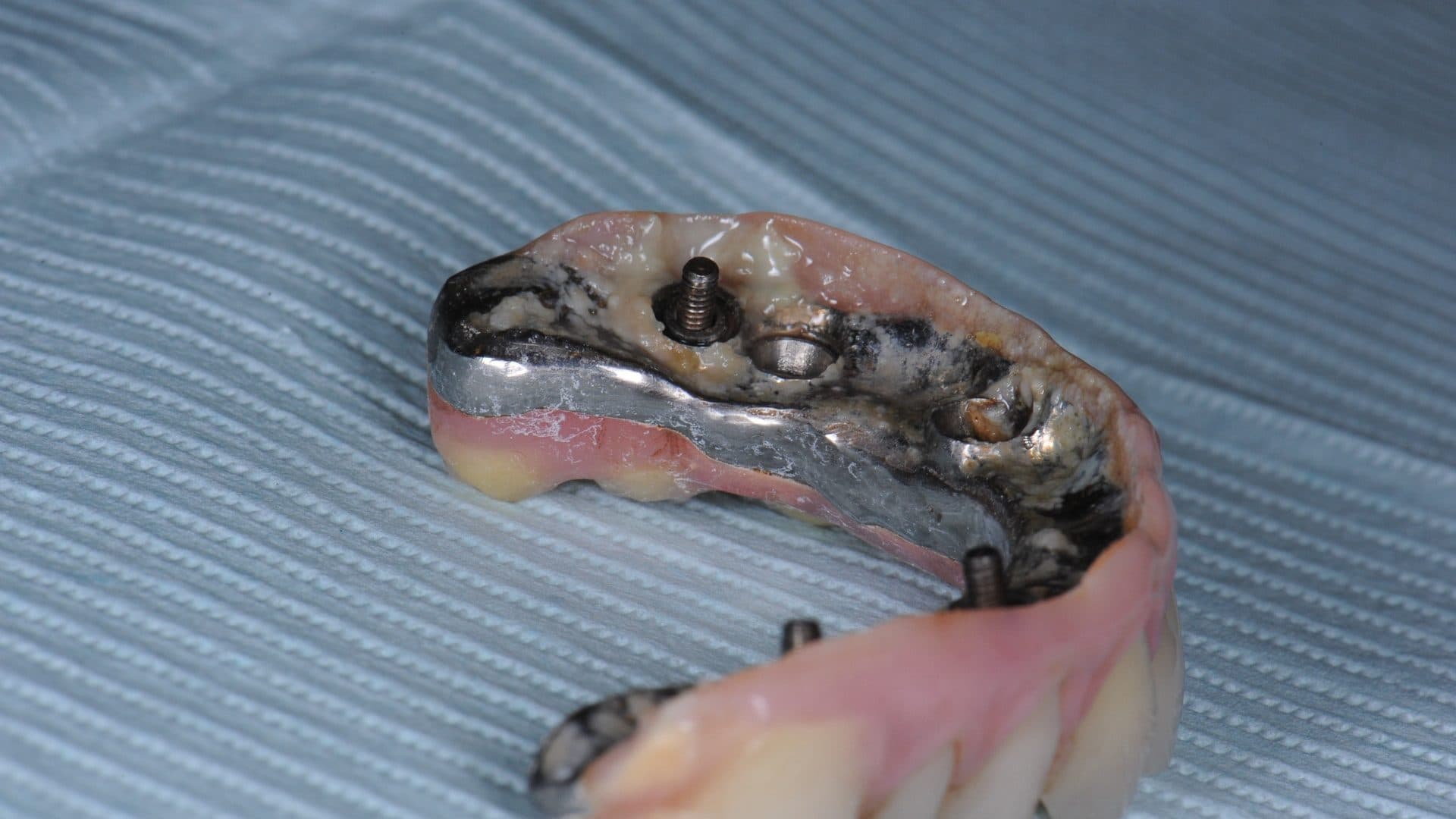 Dental Implants Complications All On 6 Poor Placement Mini Flanges Cleaning Problems Infections Bone Loss 5 DSC 5170 405 Web