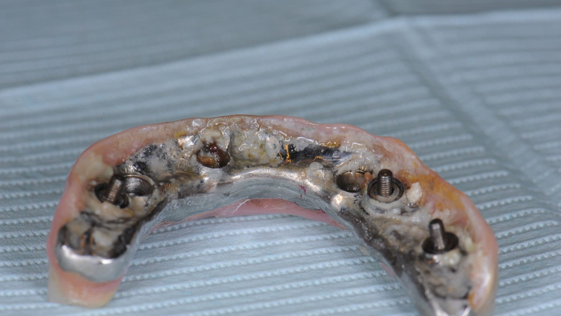 Dental Implants Complications All On 6 Poor Placement Mini Flanges Cleaning Problems Infections Bone Loss 6 DSC 5167 449 Web