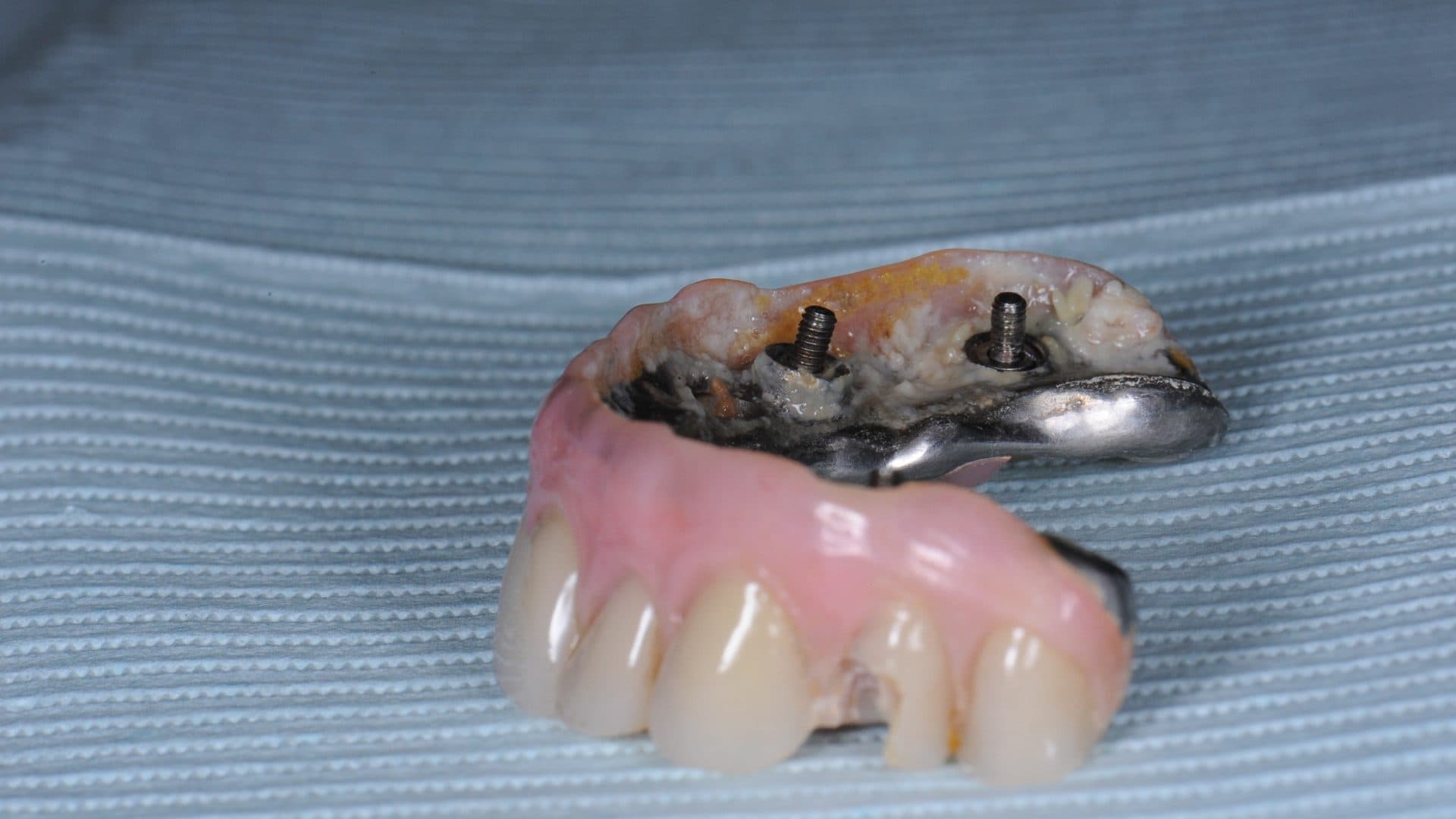 Dental Implants Complications All On 6 Poor Placement Mini Flanges Cleaning Problems Infections Bone Loss 7 DSC 5171 306 Web