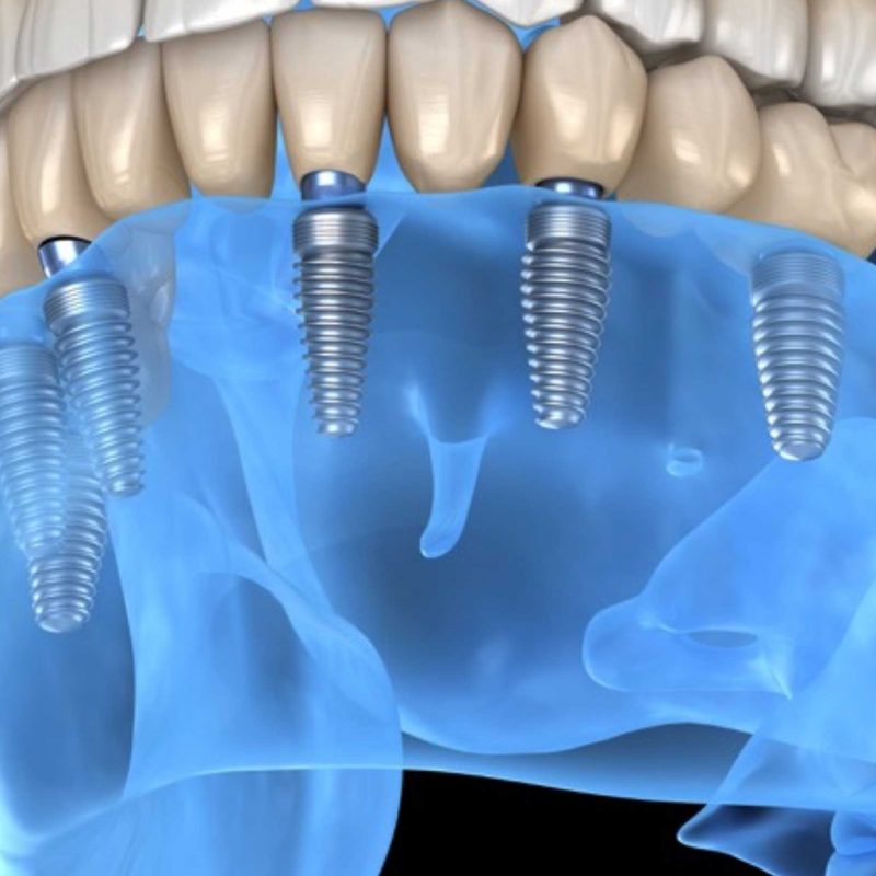 Dental implant blue image